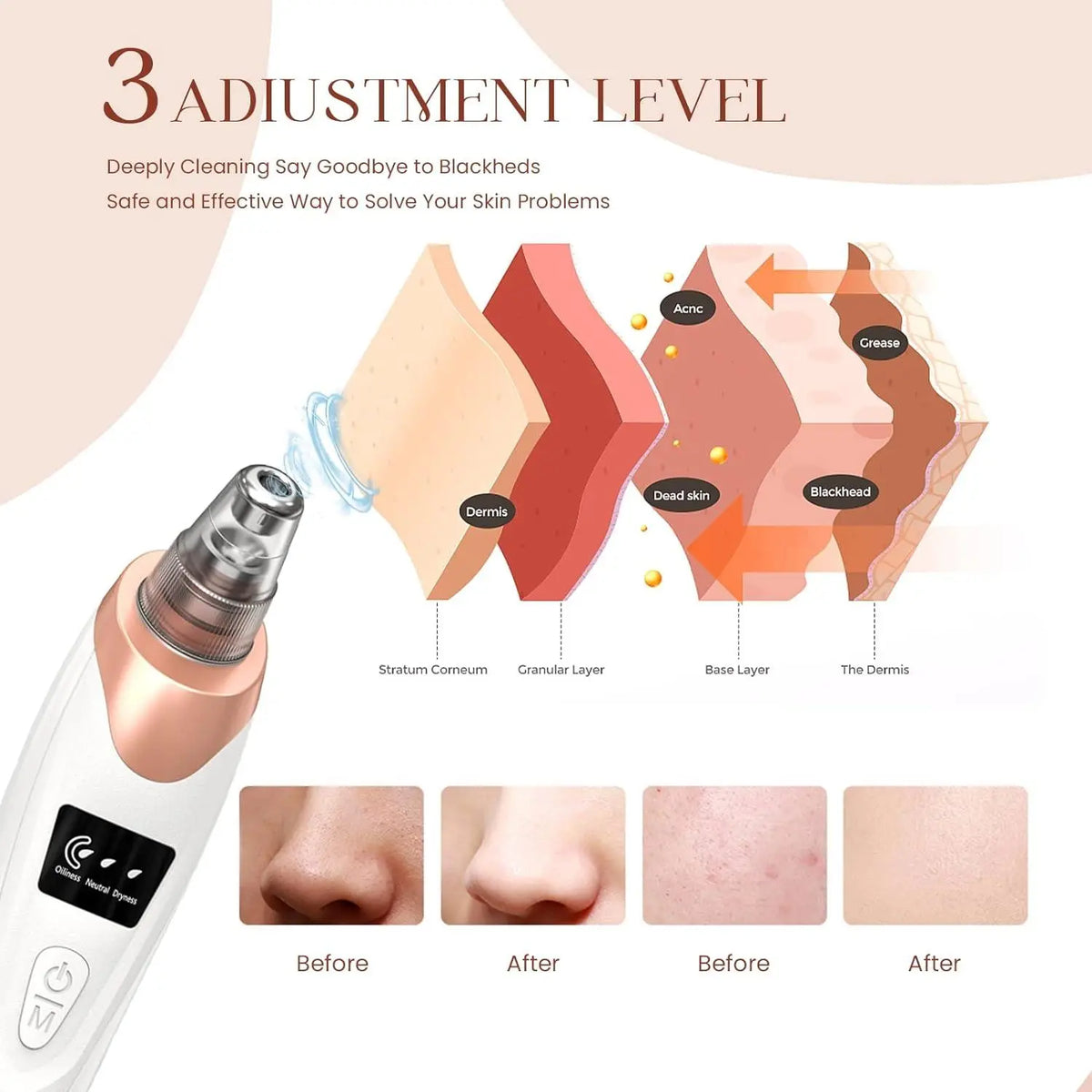 Blackhead Remover Pore Vacuum – photo 3